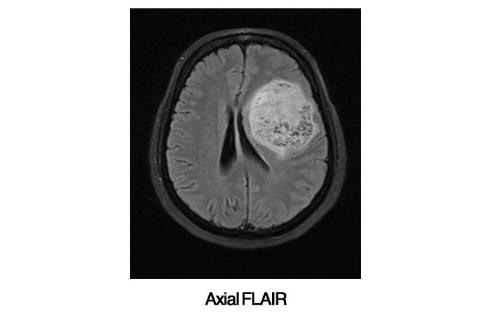 Epilepsy Axial FLAIR